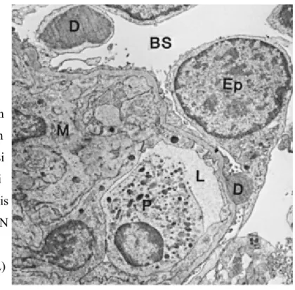 Gambar 4. Mikroskop electron pada GNAPS memperlihatkan deposit electron dense (D) di sisi epitel (Ep) dari membrane basalis glomerulus