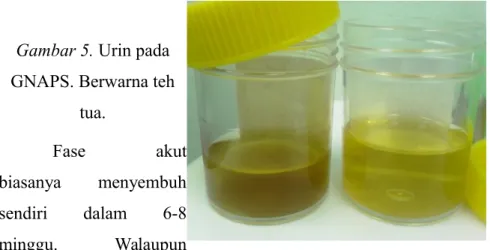 Gambar 5. Urin pada GNAPS. Berwarna teh