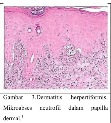 Gambar  3.Dermatitis  herpertiformis.