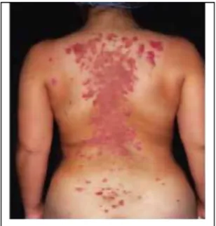 Gambar 4.Pemfigus Vulgaris 6