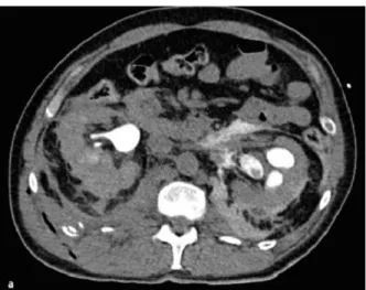 Gambar 6. Tampak ruptur renal bilateral pada pemeriksaan CT-scan  potongan axial (15)