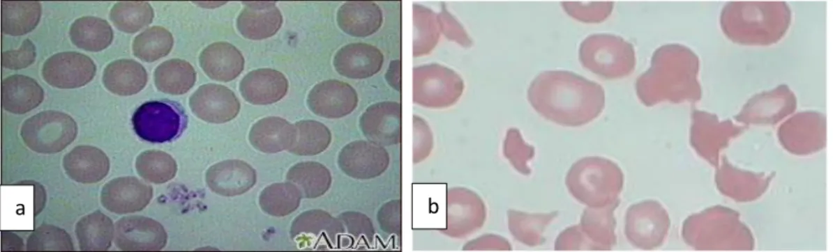 Gambar  2.1  Gambaran  mikroskopis  hapusan  darah  (a)  normal  (b)  anemia  hemolitik (dikutip dari kepustakaan no.7) 