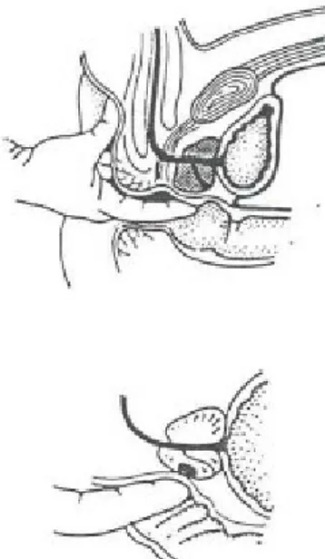 Gambar 2.2 Pemeriksaan Rectal Toucher Derajat berat hiperplasia prostat berdasarkan gambaran klinis 1