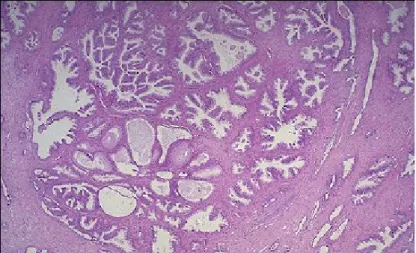 Gambar 2.3 Histopatologi Pembesaran Prostat Jinak