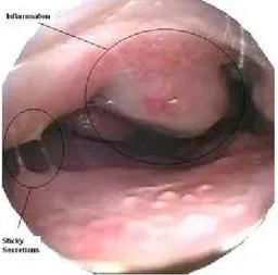 Gambar 2.6 : Concha pada pasien rhinitis alergi (16)