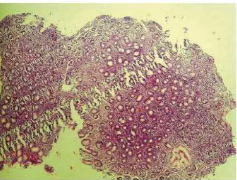 Gambar 3 .Gastritis erosiva (Szoke D, 2009)17 