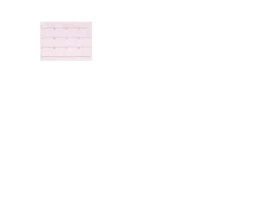Gambar 11. Rekaman EKG Atrial Fibrilasi dengan respon normal