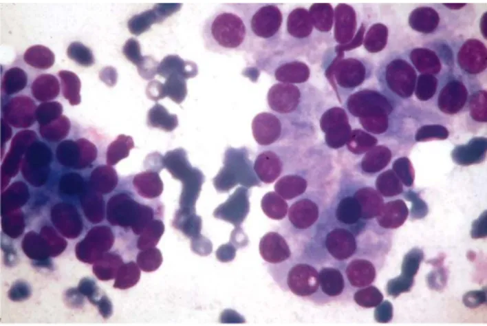 Gambar 1. Karsinoma Folikular. Agregat sel-sel folikular dengan nukleus besar dan intranuclear  cytoplasmic inclusion kecil
