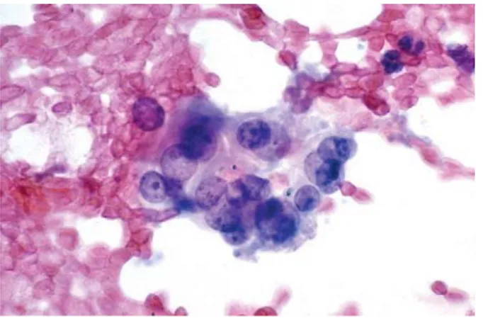 Gambar 3. Karsinoma Folikular. Sel-sel tumor menunjukkan nukleolus yang prominen di dalam  nukleus besar