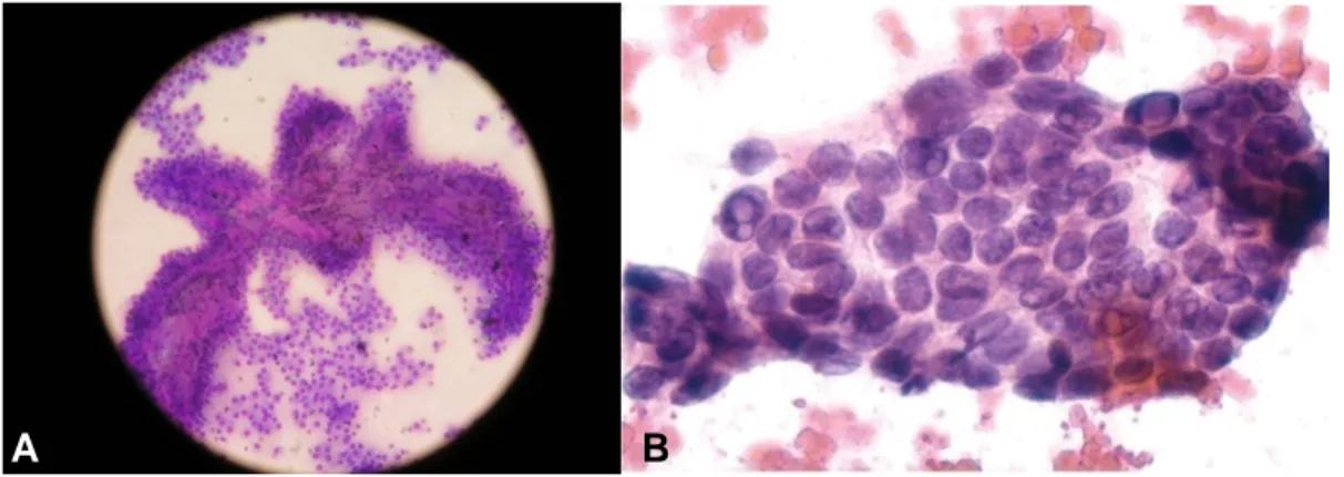 Gambar 5. Karsinoma papiler tiroid. A. Multilayered, susunan papiler kompleks sel-sel folikular  merupakan diagnostik dari karsinoma papiler (MGG, 20x)
