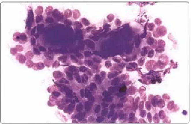 Gambar 7. Follicular variant of papillary carcinoma. Pola arsitektur mikrofolikular dari syncytial  cluster dan folikel yang mengandung koloid, nukleus membesar, pucat, beberapa dengan intranuclear  vacuoles (MGG, HP)