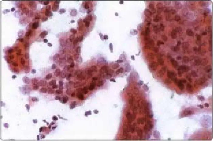 Gambar 9. Columnar cell variant of papillary carcinoma. Agregat dan fragmen papiler dengan nukleus  besar yang bertumpang tindih, sel kolumnar tapi tidak tinggi, nukleus ireguler, beberapa nukleolus  prominen (Pap, HP)