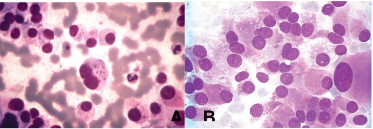 Gambar 11. Karsinoma meduler tiroid. A. Sitoplasma bergranul. B. Sel-sel malignan hampir  menyerupai sel-sel plasma (MGG)