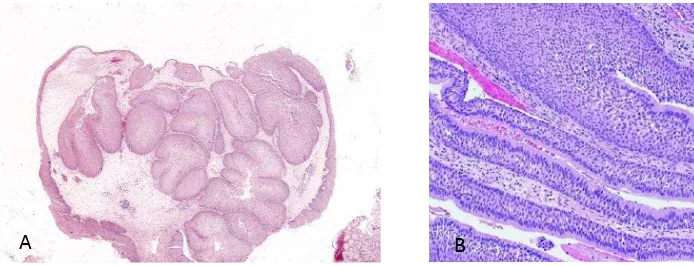 Gambar 2.5. berupa epitel skuamosa yang tumbuh hiperplastik ke dalam stroma. B. Terdiri dari epitel skuamosa dan epitel repiratori bersilia.Inverted papilloma