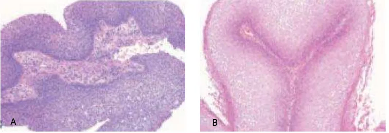 Gambar 2.6. Oncocytic papilloma. Tampak pola pertumbuhan eksofitik, dengan pelapis epitel onkositik berlapis, disertai kista berisi musin intraepitelial dan mikroabses.1,119 