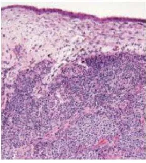 Gambar 2.8. Ectopic pituitary adenoma berupa tumor di mukosa nasofaring yang seluler dan tidak berkapsul, dengan epitel permukaan yang masih intak.1 