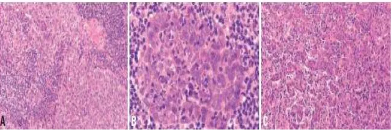 Gambar 2.11.  Non keratinizing squamous cell carcinoma, undifferentiated type. A. Sel-sel limfoid yang terbentuk dalam agregat kecil