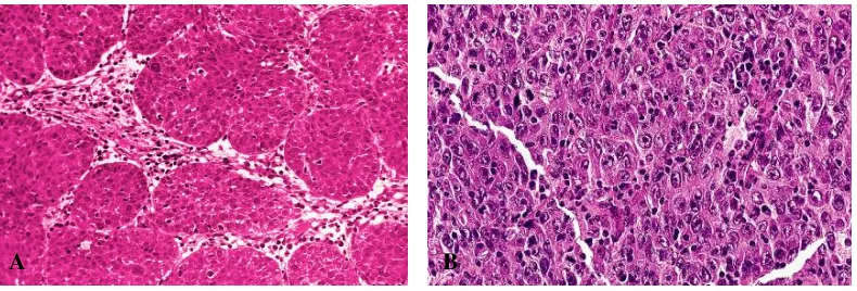 Gambar 2.12. Undifferentiated carcinoma. A. Tipe Regauds, terdiri dari sel-sel yang membentuk sarang-sarang padat