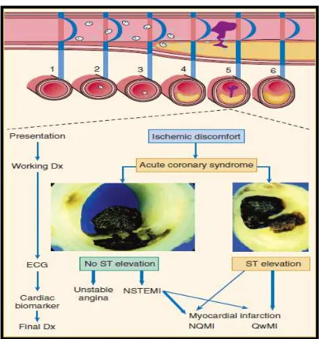 Gambar 3. Patofisiologi terjadinya sindroma  koroner akut (Hamm dkk,2004) 