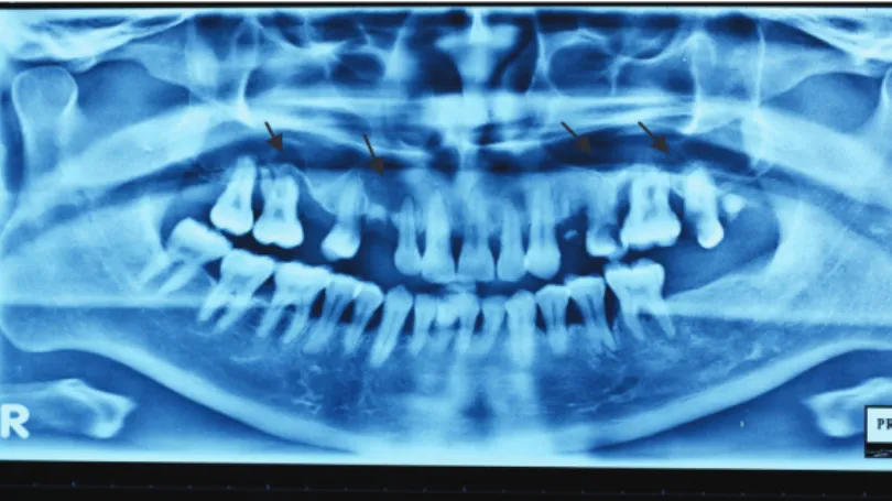 Gambar 1. Gambaran radiologis kista radikular pada apeks gigi 16, 13-12, 25-26, dan 26-27.