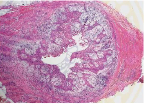 Gambar 2.2 :  Gambaran Histopatologis kista radikular 