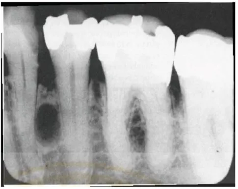 Gambar 2.3 :  Gambaran radiologis kista lateral periodontal 