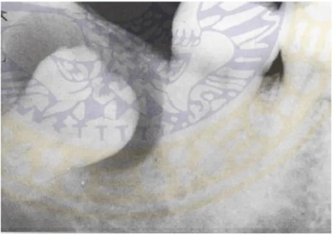 Gambar 2.5 :  Gambaran radiologis kista dentigerous 