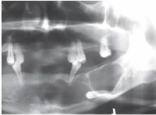 Gambar 2.7 :  Gambaran radiogis kista keratosis odontogenik 