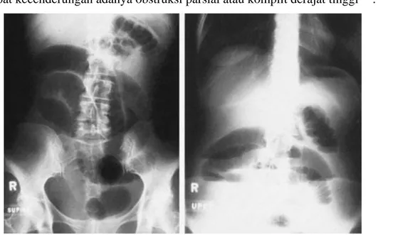 Gambar 6. Obstruksi usus halus(kiri) foto polos abdomen pasien dengan obstruksi usus halus posisi supine .(kanan)  foto dari pasien yang sama dengan posisi tegak, menunjukkan adanya air-fluid levels