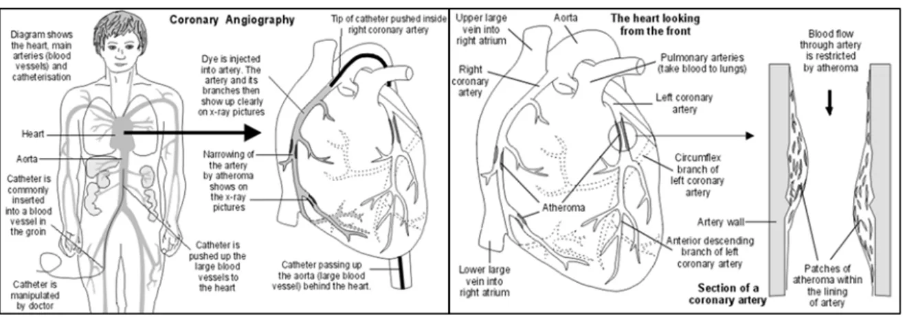 Gambar 2.2 : Cara tatalaksaan &amp; gambaran stenosis pada Angiografi  Koroner 