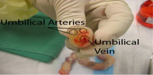Gambar 5. Potongan tali pusat dengan dua arteri dan satu vena. Dikutip dari: Maternity, Gynaecology, Infertility & Endoscopic (keyhole) Surgery Mumbai (Bombay), India