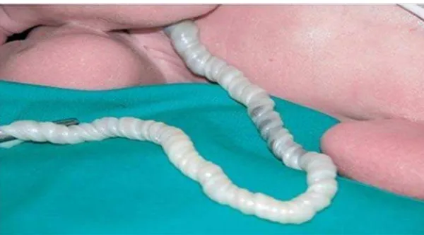 Gambar 10.    Hypercoiling umbilical cord. Dikutip dari: Daniele et al.                           Journal Pediatric (2007) 