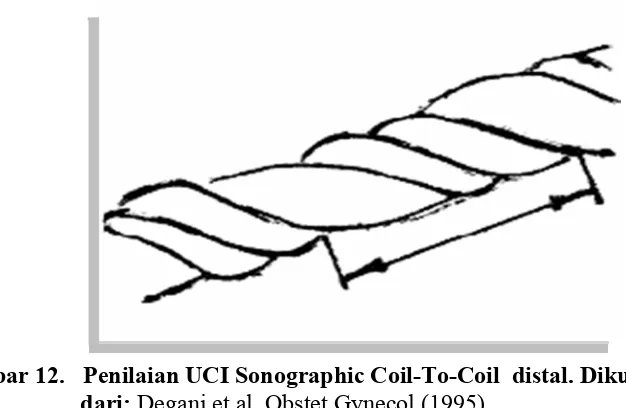 Gambar 12.   Penilaian UCI Sonographic Coil-To-Coil  distal. Dikutip  