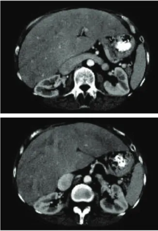 Gambar 1. A. Congestive hepatopathy pembesaran vena cava in�erior.den�an pembesaran vena renalis� B