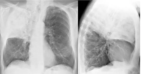 Gambar 4. Gambaran pneumonia lobaris lobus superior paru kanan pada foto toraks proyeksi PA dan lateral