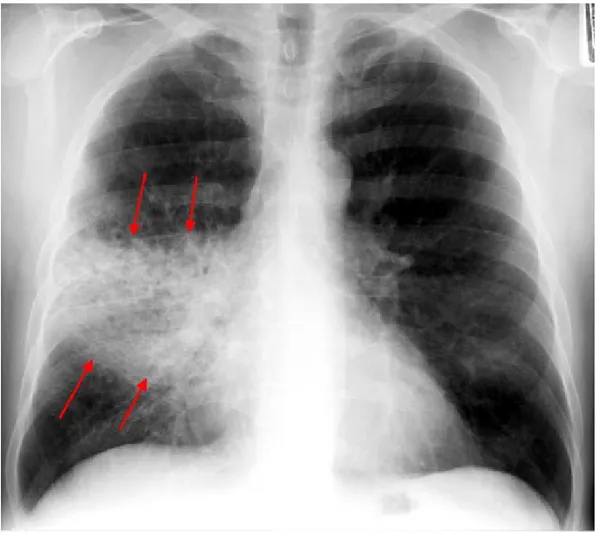 Gambar 5. Gambaran pneumonia lobaris lobus medius paru kanan
