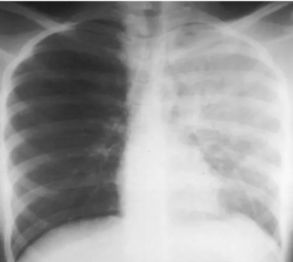 Gambar 7. Gambaran pneumonia lobaris lobus superior dan inferior paru kiri