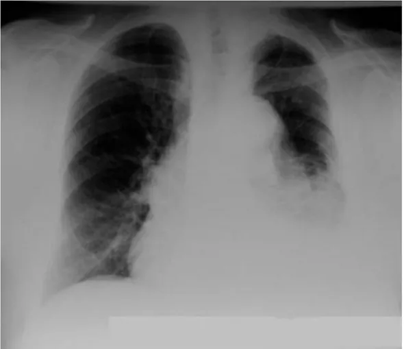 Gambar 8. Gambaran pneumonia lobaris lobus inferior paru kiri disertai penyulit efusi pleura kiri (pleuropneumonia paru kiri)