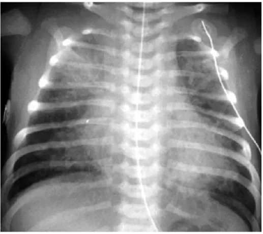 Gambar 9. Gambaran pneumonia aspirasi pada bayi disebabkan oleh aspirasi mekoneum. Ditemukan bercak di lobus kanan atas