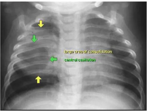 Gambar 10. Gambaran pneumonia staphylococcus dengan pneumatocele pada kanan atas dan disertai gambaran bercak mengawan pada paru kanan medial (8)