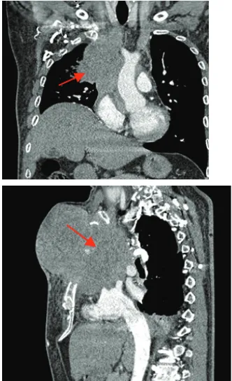 Gambar 2. �asil pemeriksaan CT scan toraks