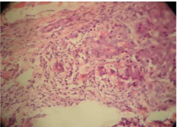 Gambar 1. Skor 1 sebukan sel mononuklear di sekitar jaringan adenokarsinoma mammae mencit C3H (sel MN <25%)