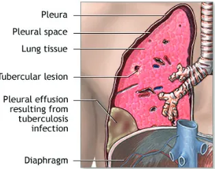 Gambar 1. �le��itis t�be�k�losis den�an e��si ple��a�S�mbe� : https://www.nlm.nih.�ov/medlinepl�s/�