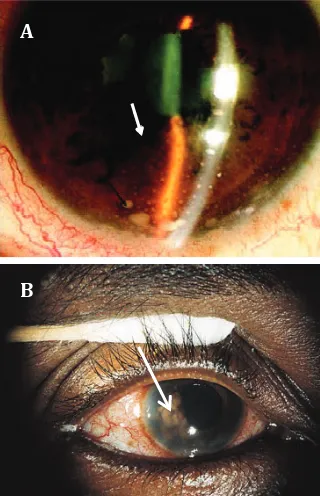 Figure 1. Classification the clinical presentation of ocular tuberculosis5