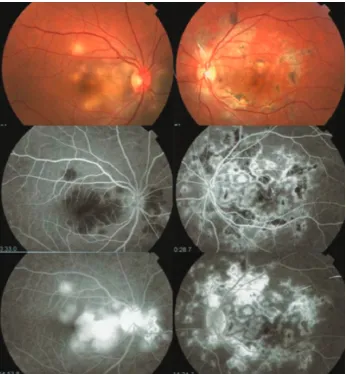 Figure 5. Fundus photography (top right and left) and fluorescein angiography (middle and buttom) in patient with persumed ocular tuberculosis shows active serpiginous-like choroiditis in the right eye and inactive serpiginous-like choroiditis in the left eye.10