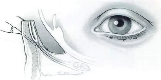 Gambar 1. Prosedur Quickert1