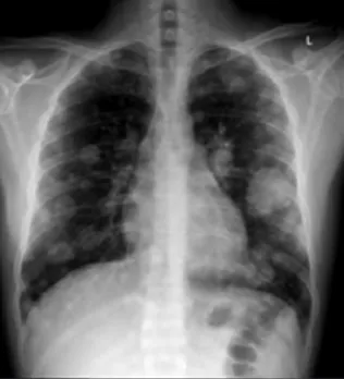 Figure 1: Chest X-ray showing bilateral, multiple, variable size, pulmonary nodules