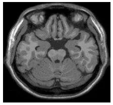 Gambar 1. Citra MRI otak 