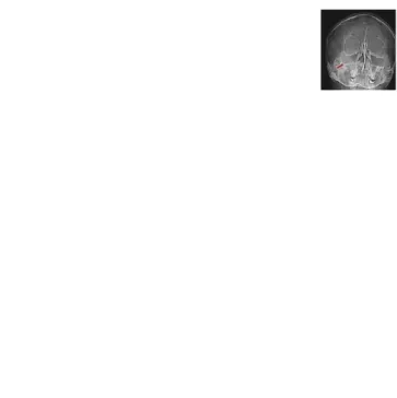 Gambar 2. Radiograf pada sinus  (posisi Waters)