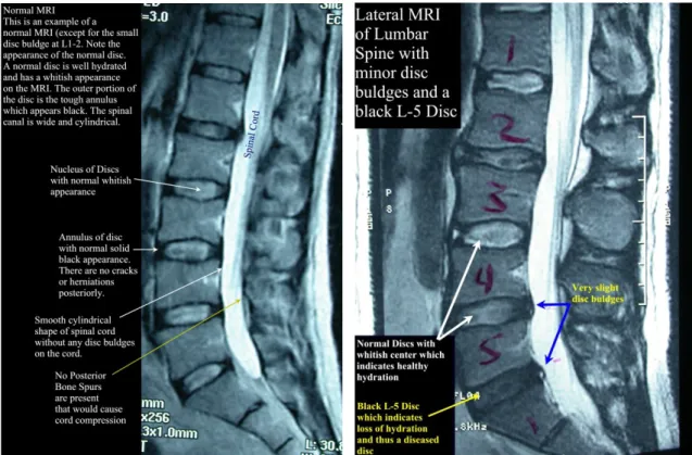 Gambar 2.2 Foto Magnetic Resonance Imaging (MRI) Lumbal